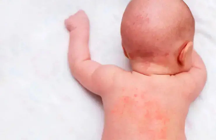 La laine mérinos peut-elle aider à lutter contre l'eczéma ?